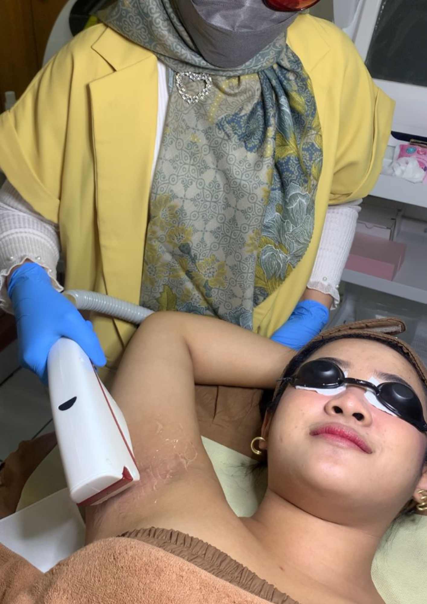 IPL Underarm Hair Removal