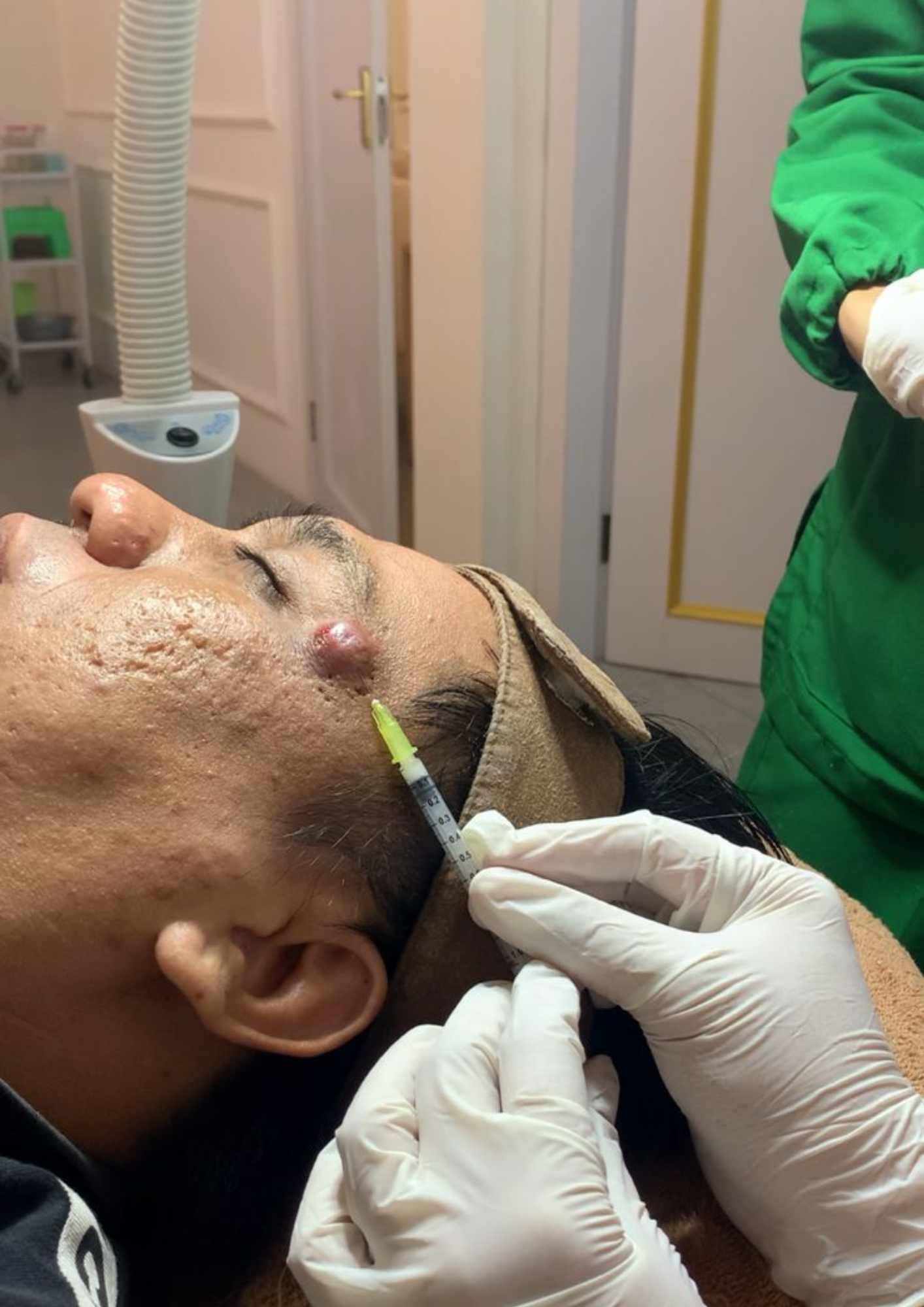 Inject Acne