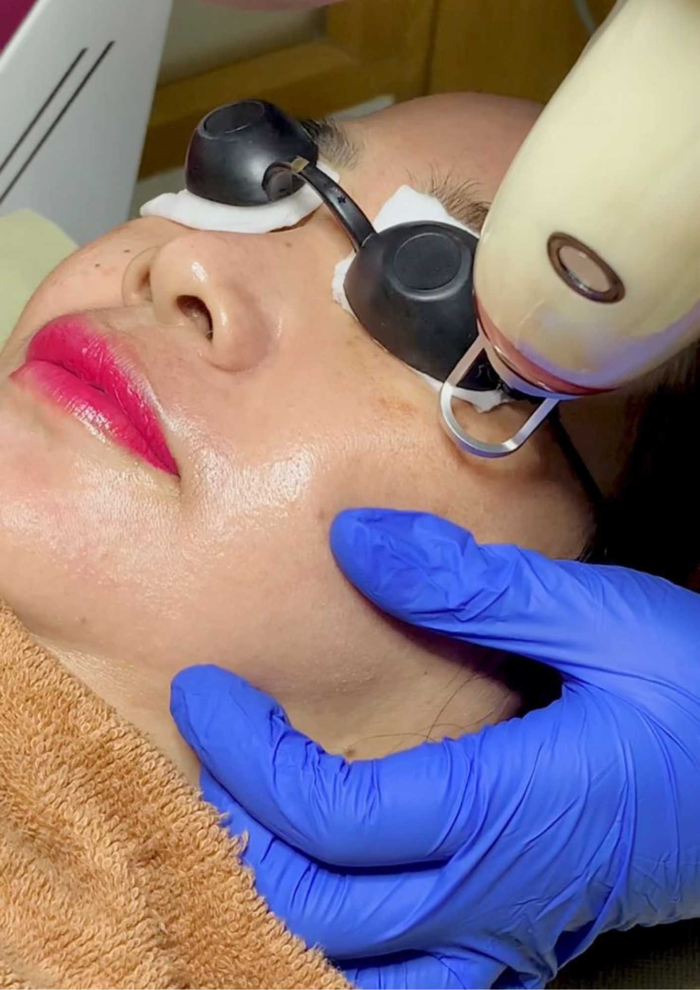Laser Melasma C Plus