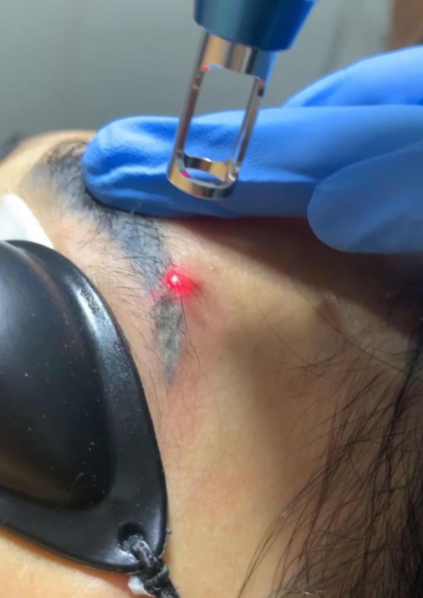 Laser Removal Sulam Alis