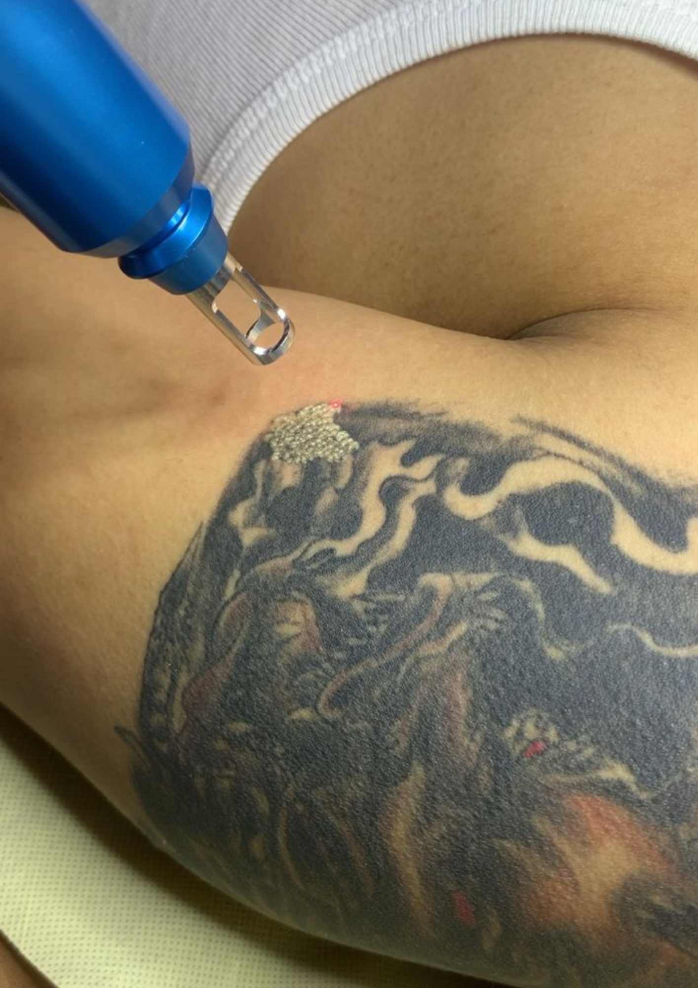 Laser Removal Tatto