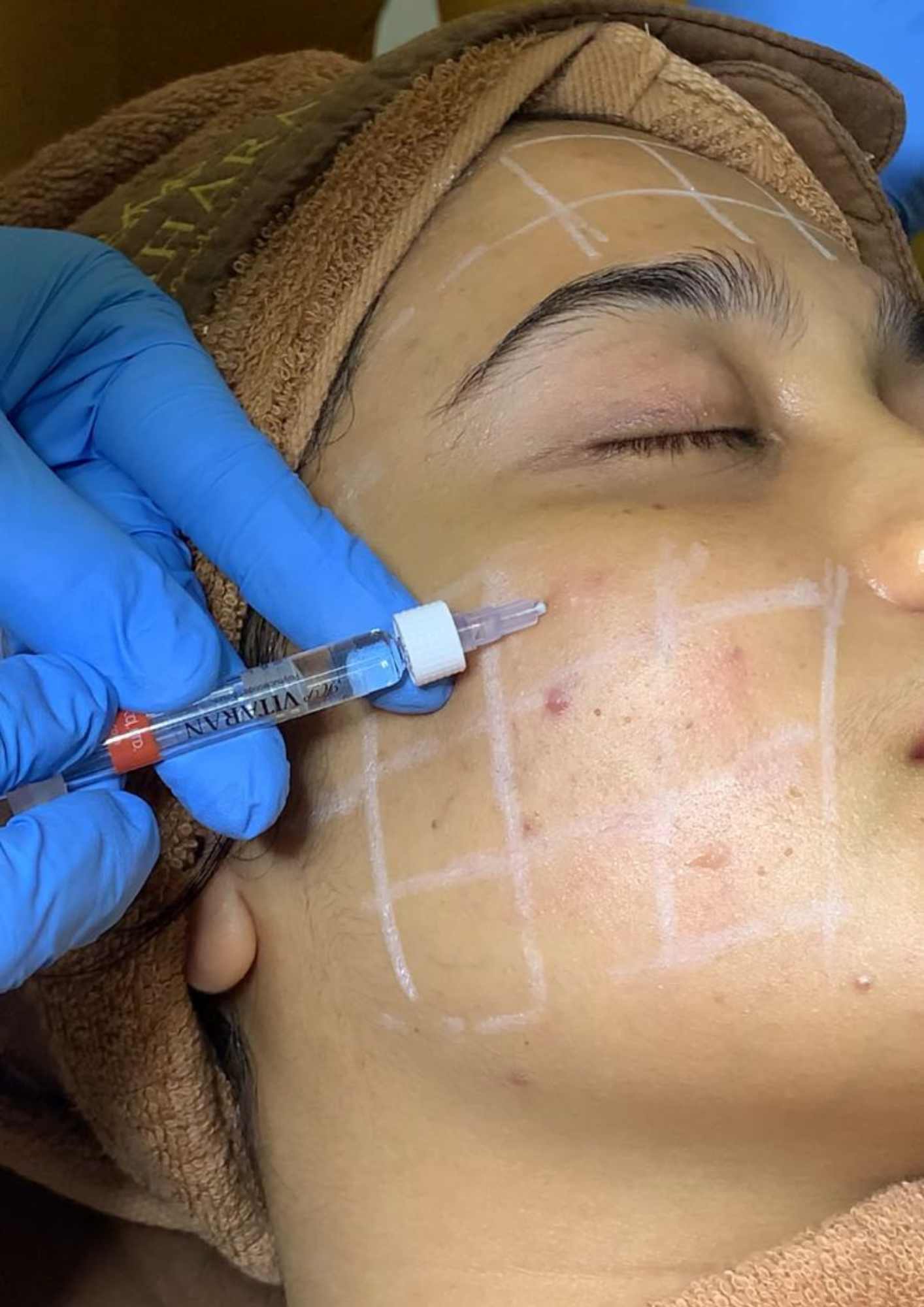 Treatment Skinbooster
