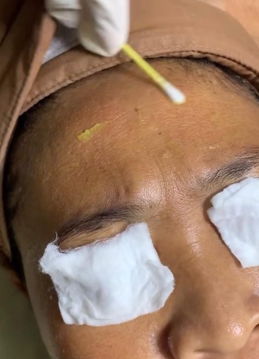 Treatment Whitening Peel