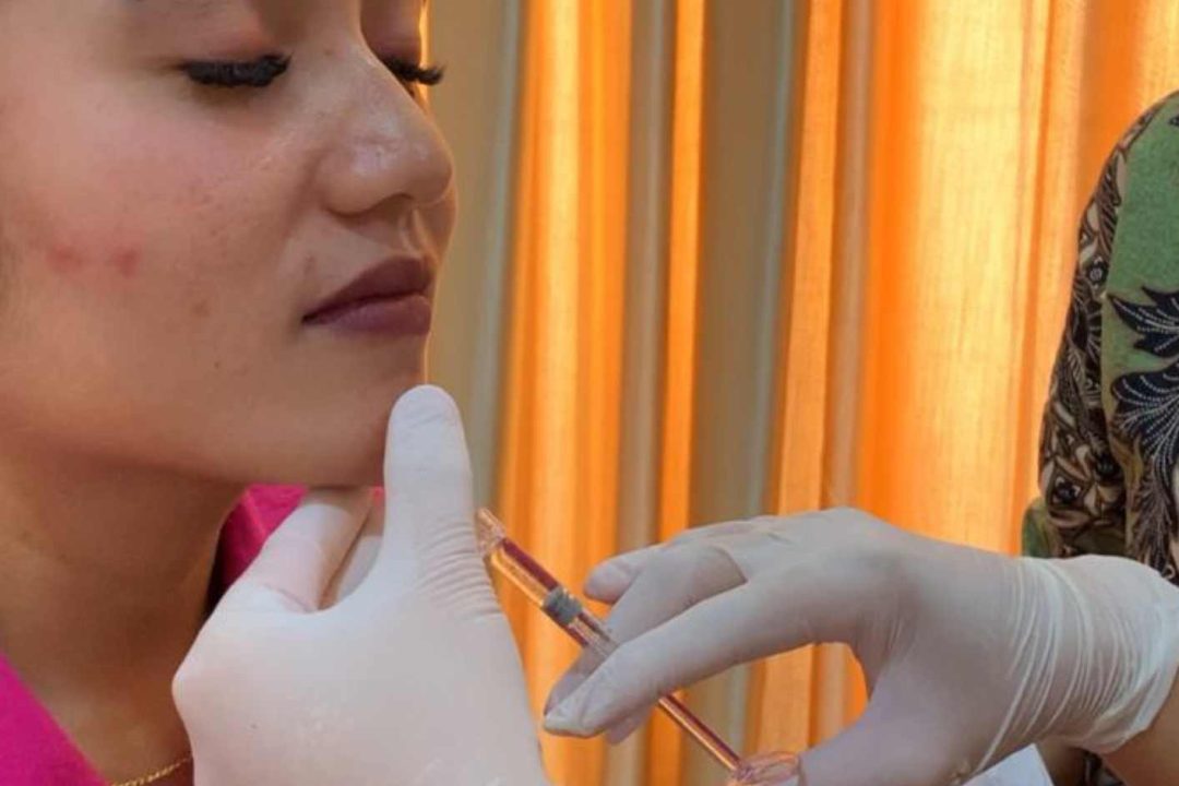 Filler Dagu