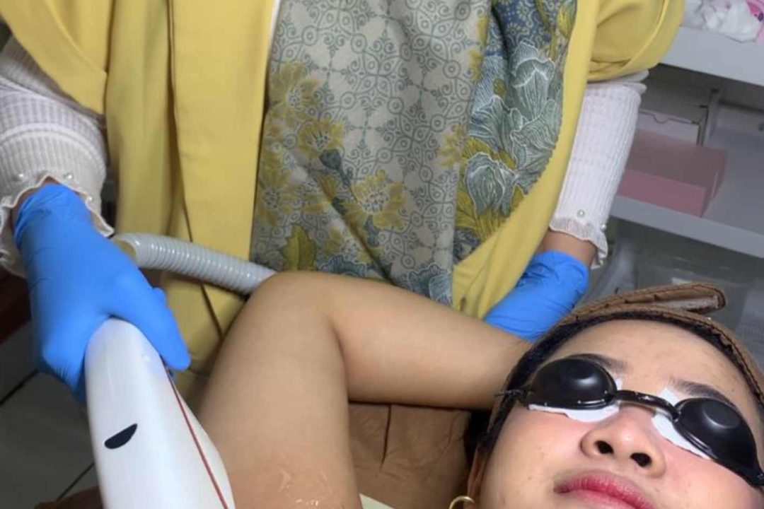 IPL Underarm Hair Removal