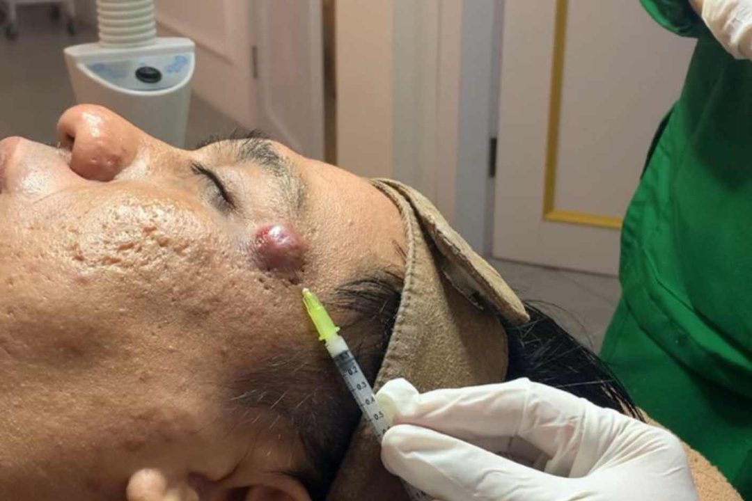 Inject Acne