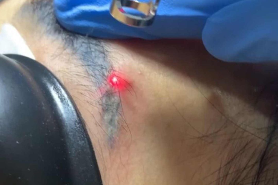 Laser Removal Sulam Alis