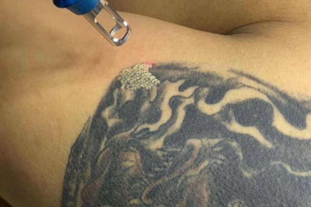 Laser Removal Tatto