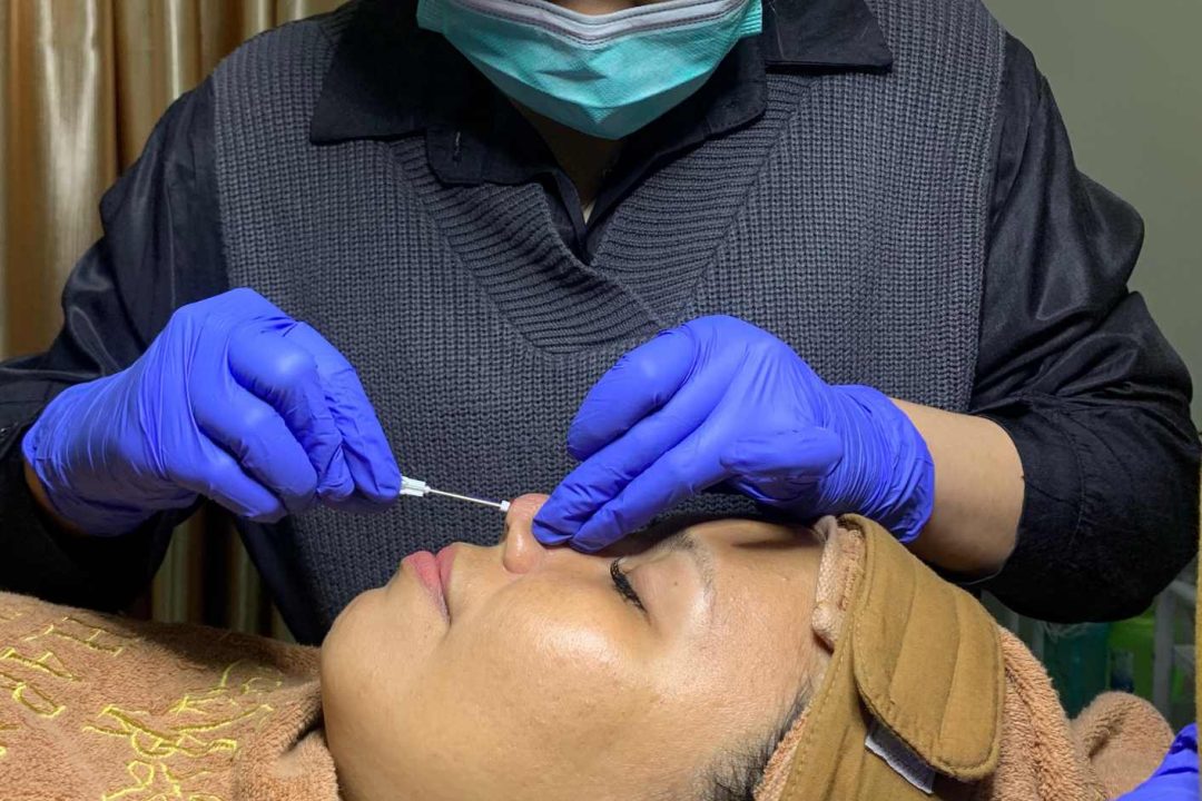 Tanam Benang Hidung