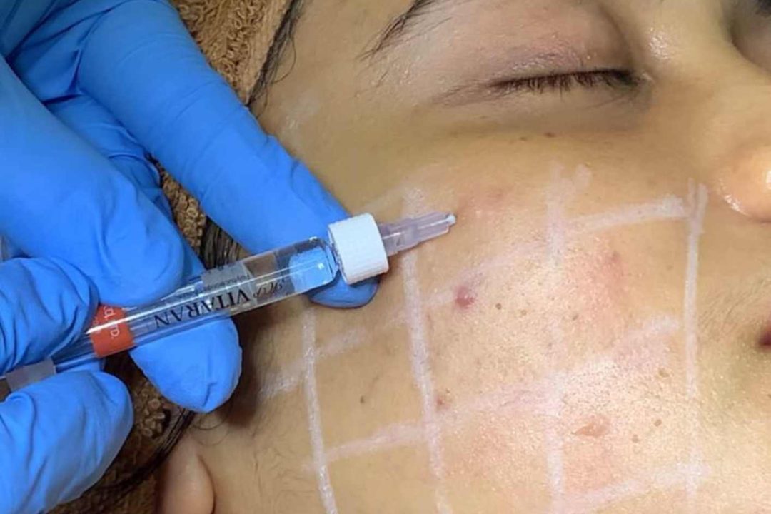 Treatment Skinbooster