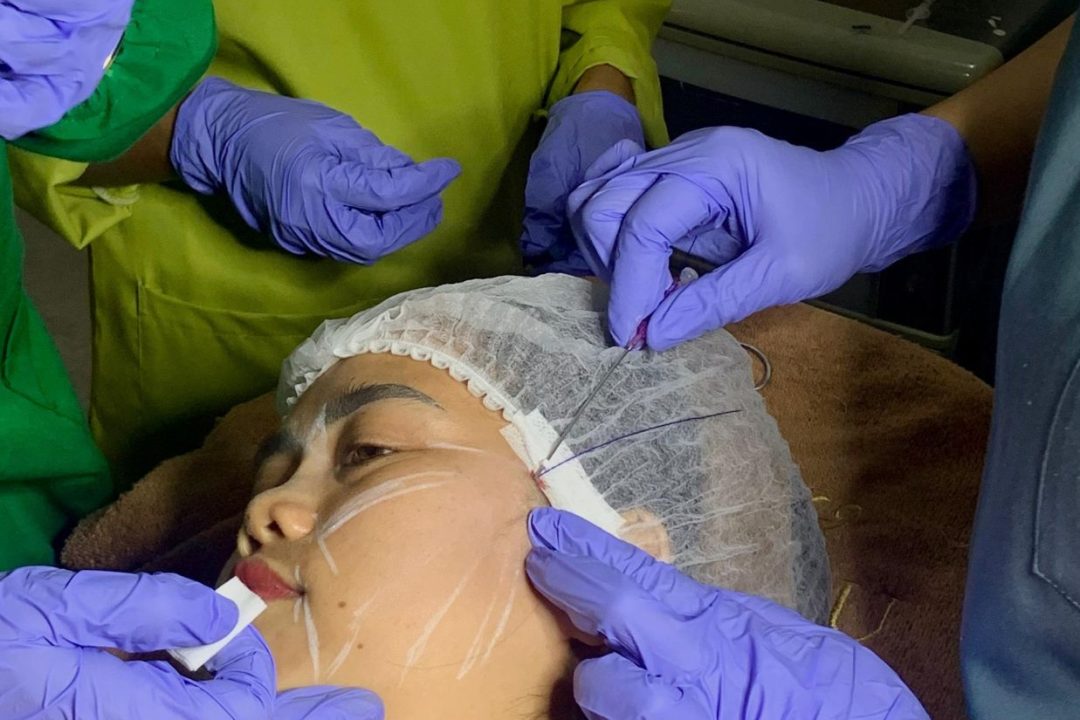 Treatment Tarik Benang VShape1
