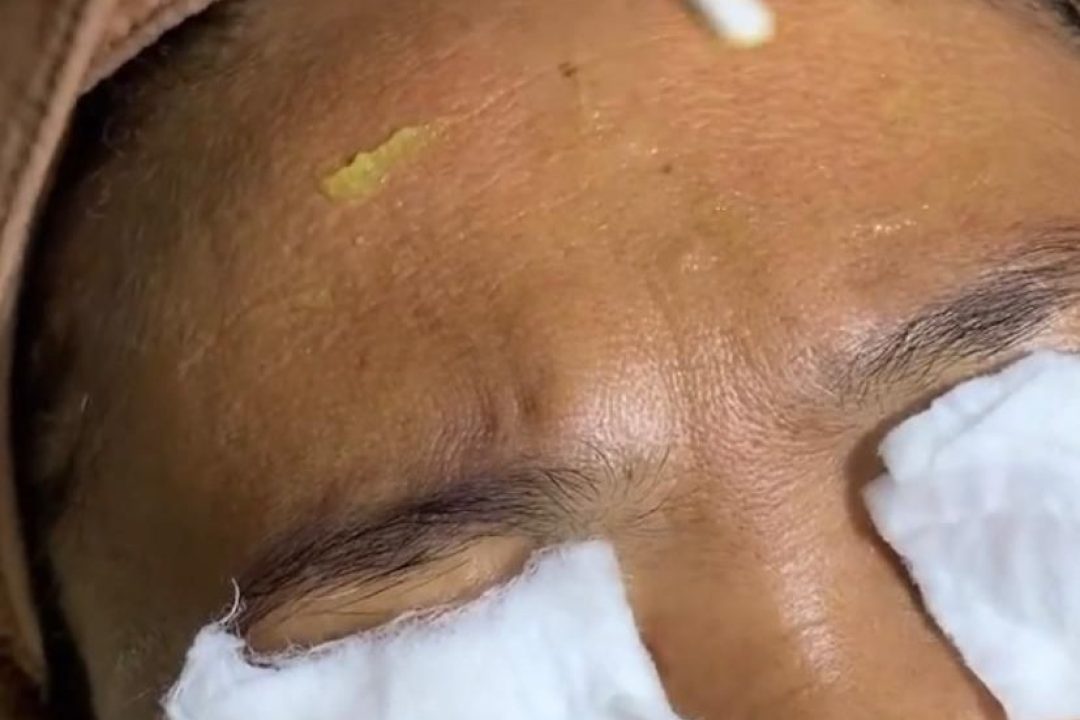 Treatment Whitening Peel